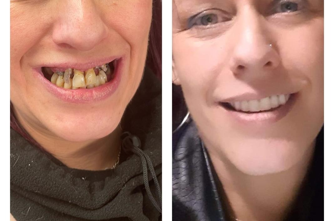 Before and after dentures at Station House Dental Care — real patient result