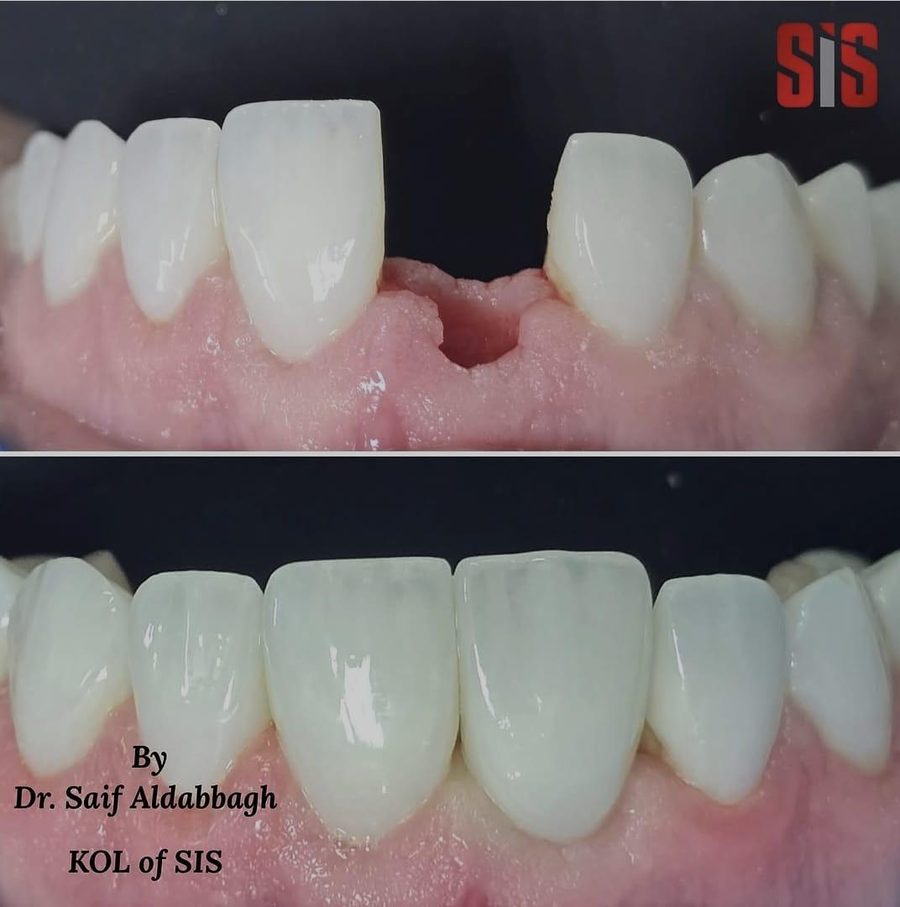 Missing front tooth restored, before and after by Dr Saif Al-Dabbagh