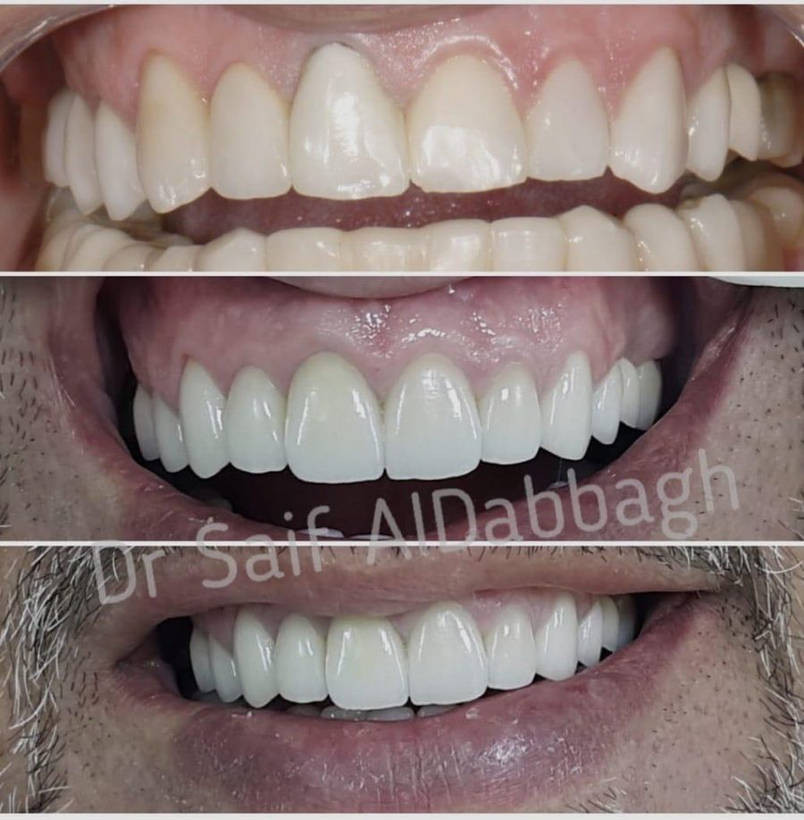 Full smile makeover before and after by Dr Saif Al-Dabbagh