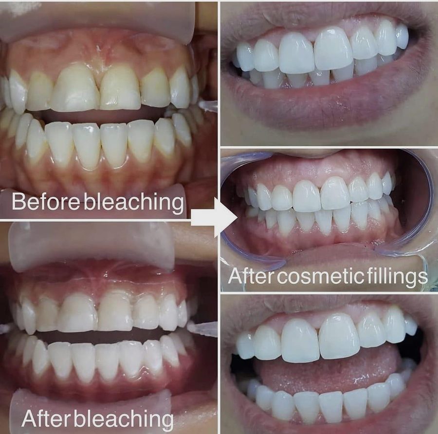 Teeth whitening followed by cosmetic fillings, staged before and after by Dr Saif Al-Dabbagh