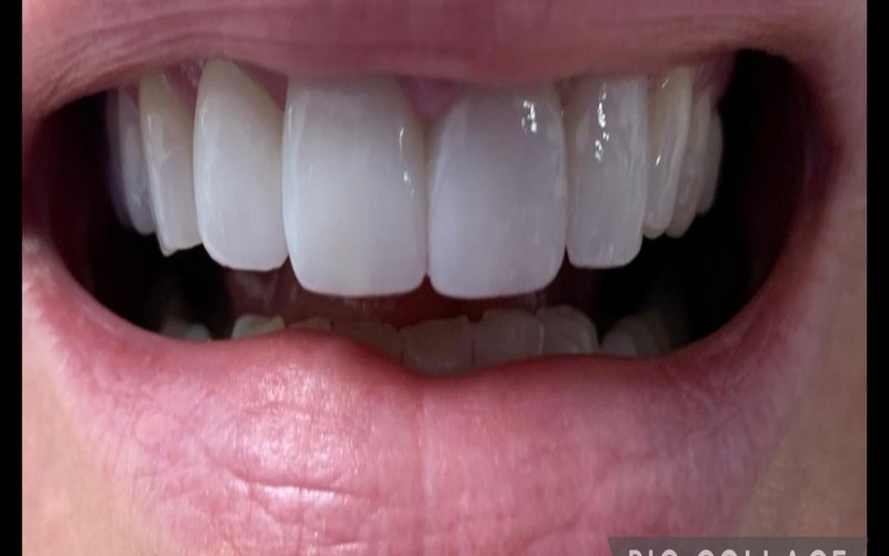 After veneers